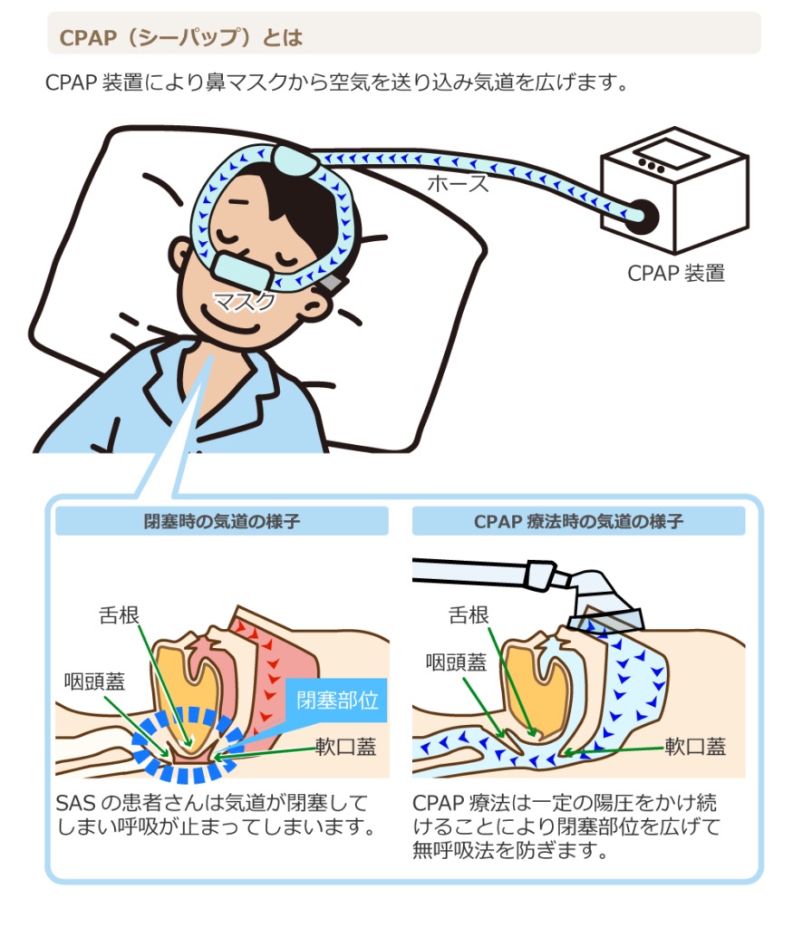 CPAP